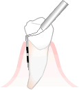 歯周治療