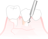 歯周治療